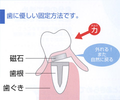 磁石式入れ歯